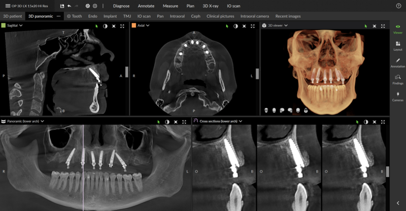 CBCT w implantologii – funkcjonalność i znaczenie